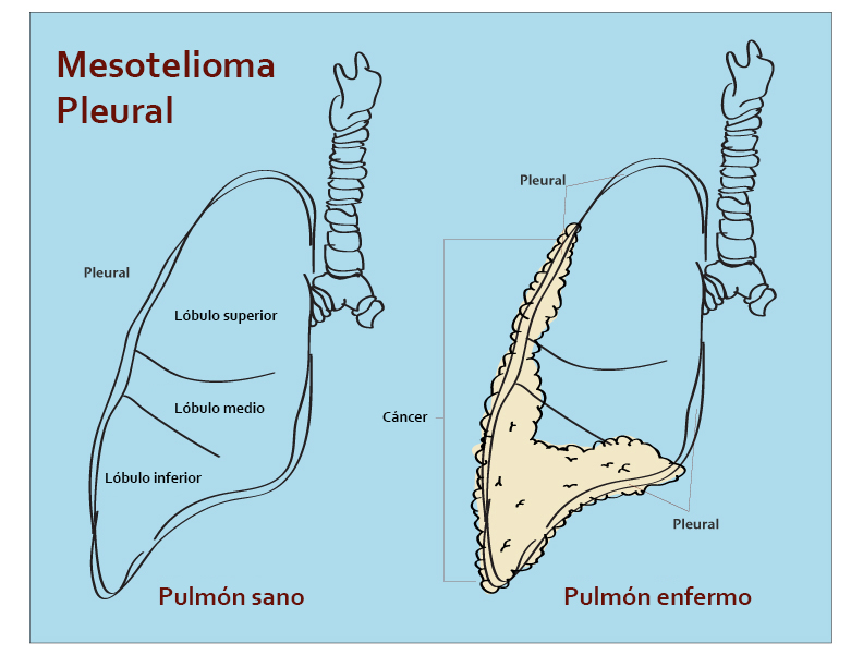 peritoneal mesothelioma treatment