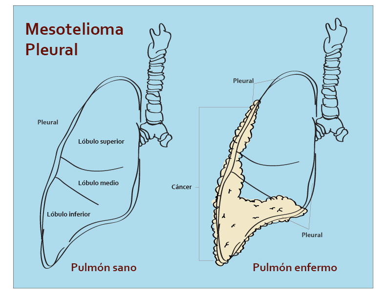 mesothelioma traduire en francais